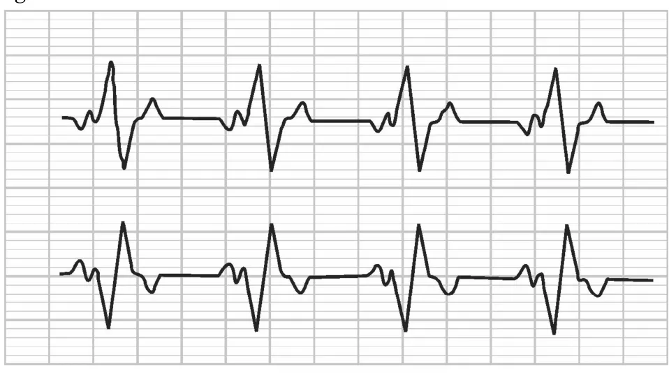 Two heart-rate traces from an electrocardiogram, each showing a repeated spike pattern on a grid.
