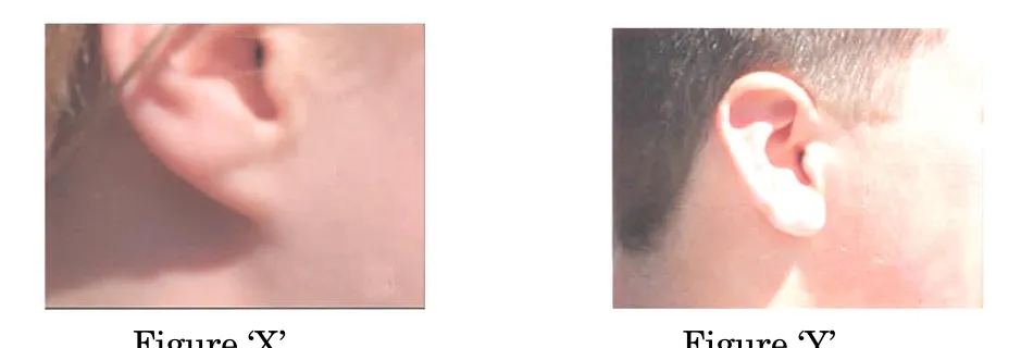 Two photographs of the side of a head. Figure X shows an ear with the earlobe attached to the head. Figure Y shows a free hanging earlobe.